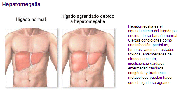 hepatomegalia