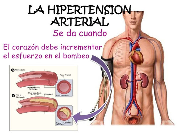 la-hipertension-arterial